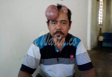 Unang, warga Seluma penderita tumor butuh uluran bantuan dermawan